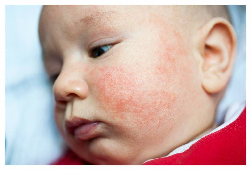 découvrez les causes, symptômes et traitements de l’eczéma chez le bébé. conseils pour apaiser les démangeaisons et prendre soin de la peau sensible de votre enfant.